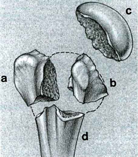 Fig 1 – Segmentos da fratura do Úmero proximal.