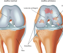 Artrose do Joelho