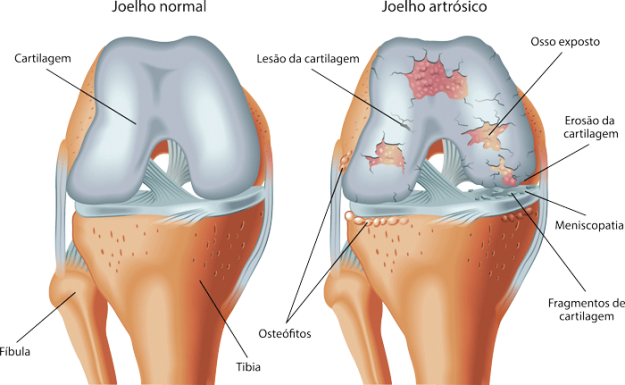Artrose do Joelho