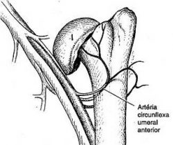 Fig 4 - Fratura em duas partes (Fratura do colo anatômico).